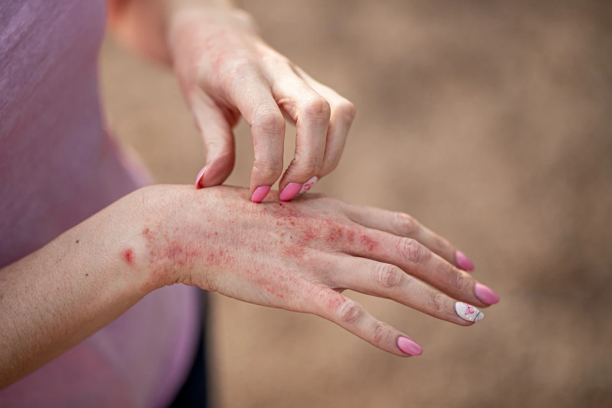 Care sunt cele mai frecvente greșeli pe care le fac pacienții cu dermatită atopică?